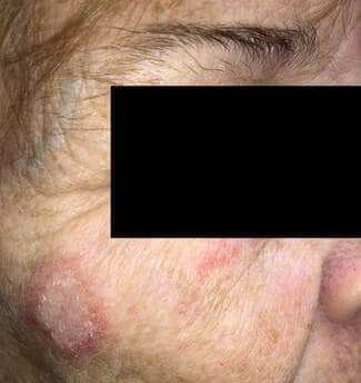 Photo of discoid lupus erythematosus on the cheek