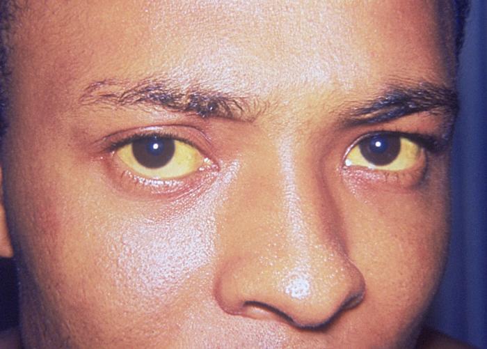 Man with yellow eyes due to jaundice from hepatitis