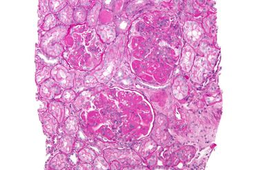 Microscopic view of diffuse proliferative lupus nephritis (class IV)