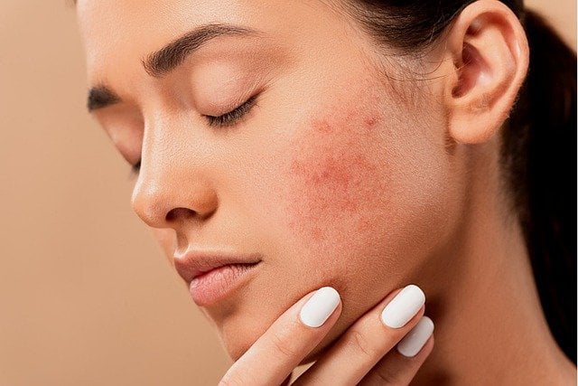 Woman who has a malar rash (butterfly rash) due to lupus with lupus disease activity