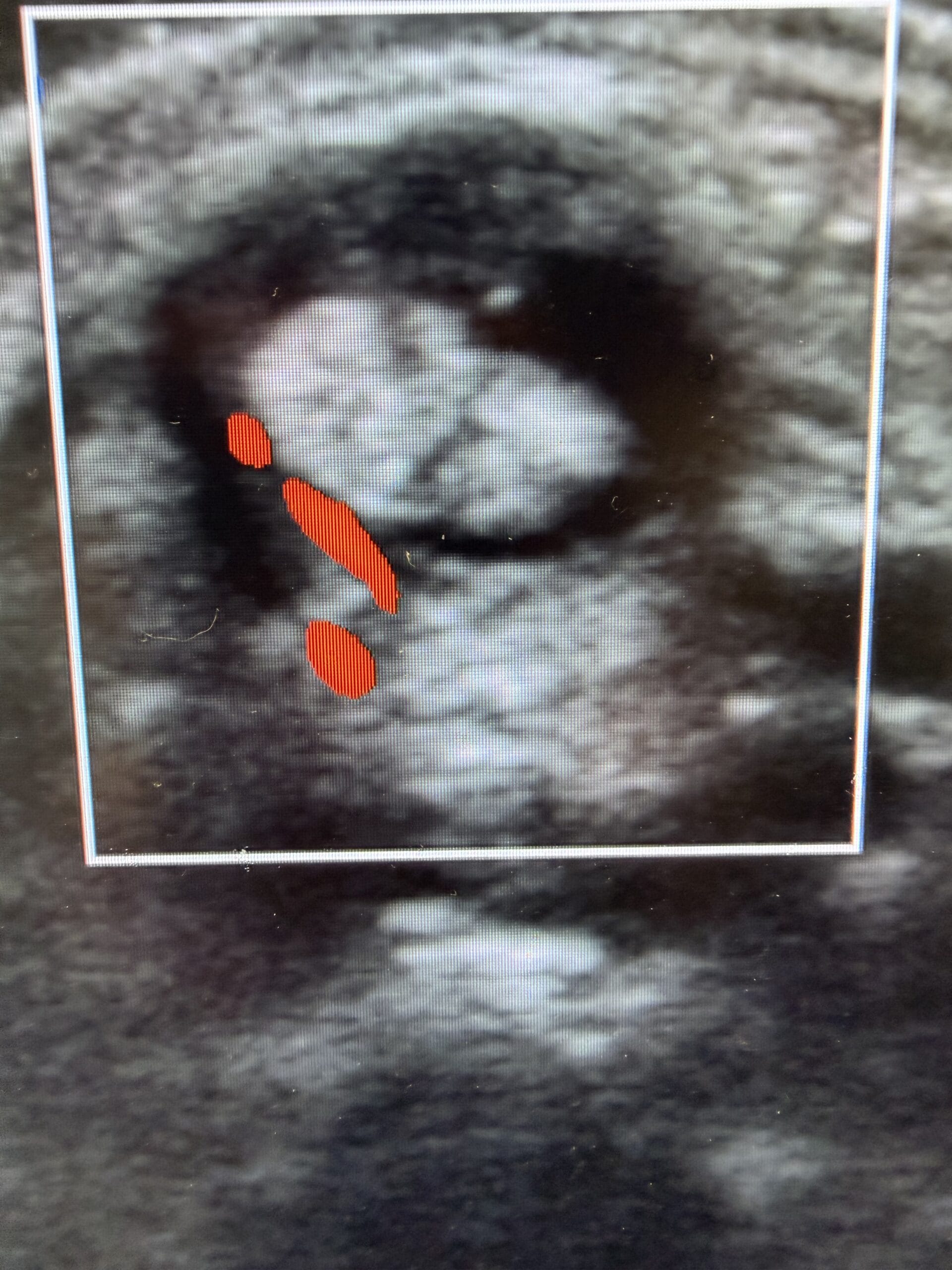 deQuervains tenosynovitis due to SLE using Doppler ultrasound showing inflammation demonstrated by the red areas around the tendons