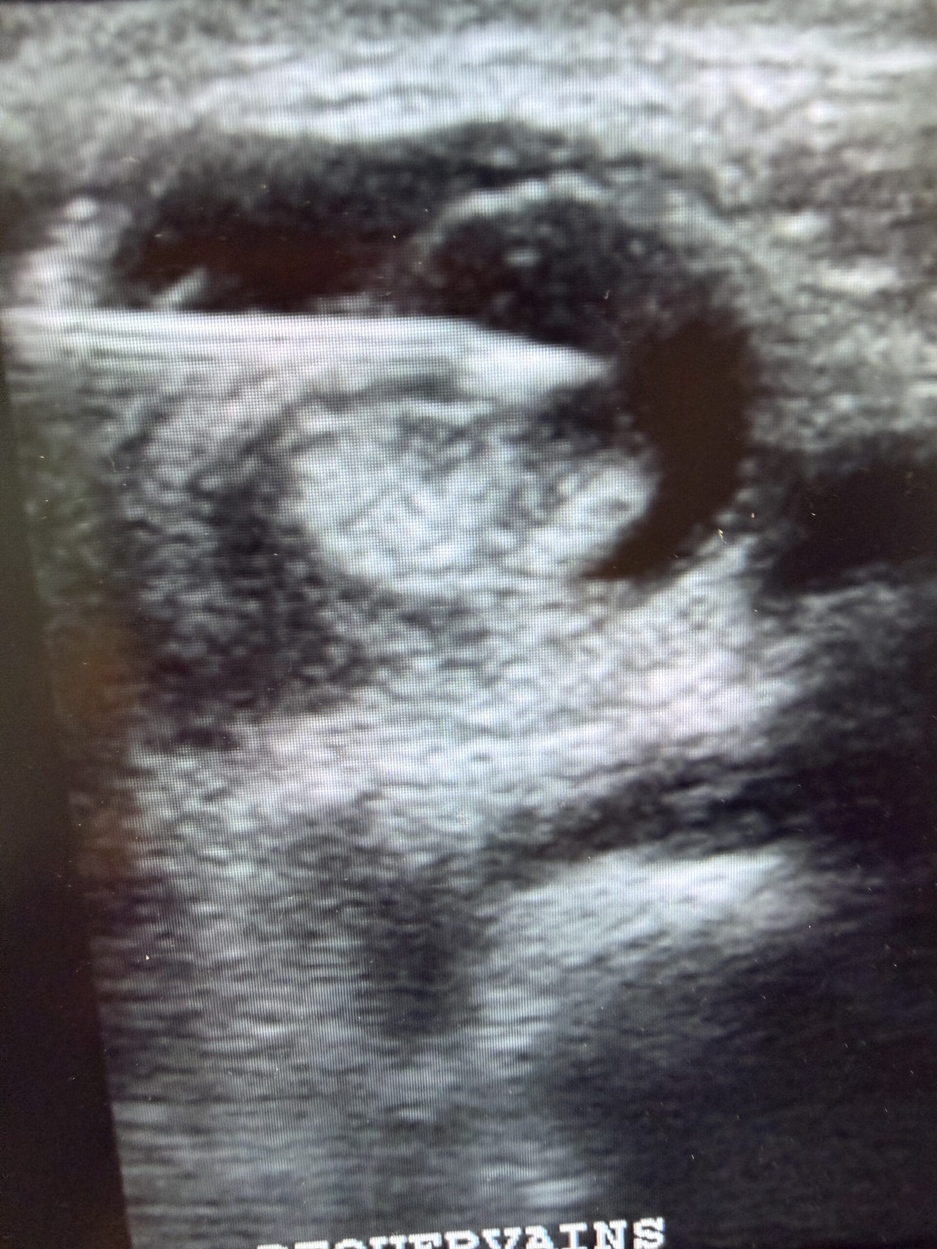 deQuervains tenosynovitis with a needle inserted into the space between the sheath and the tendons using US needle guidance