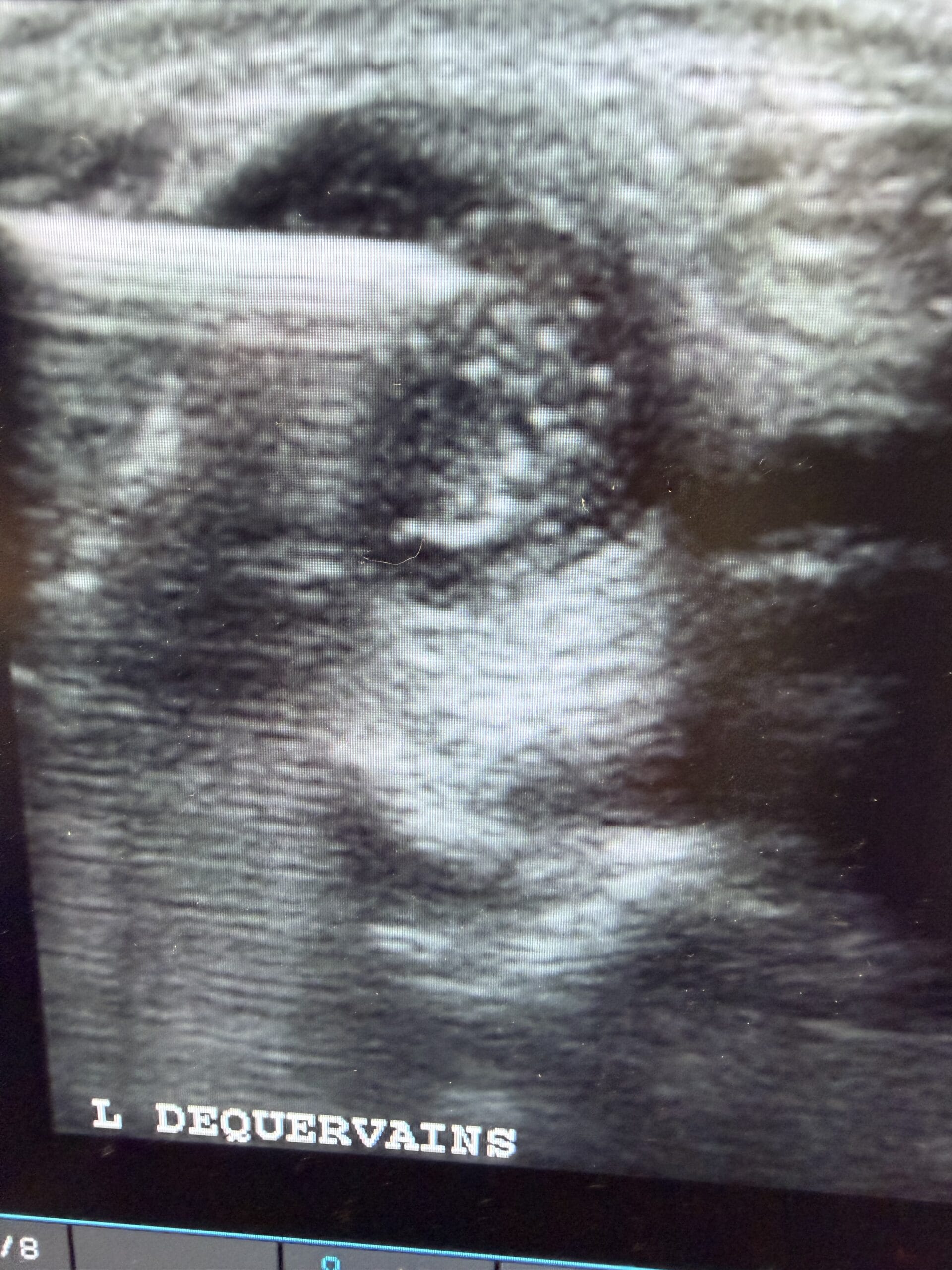 deQuervains tenosynovitis being injected with steroid, injected using US (ultrasound) guidance. The white dots are the steroid.