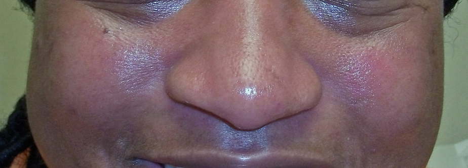 itchy skin is a sign of active lupus such as this malar rash or butterfly rash