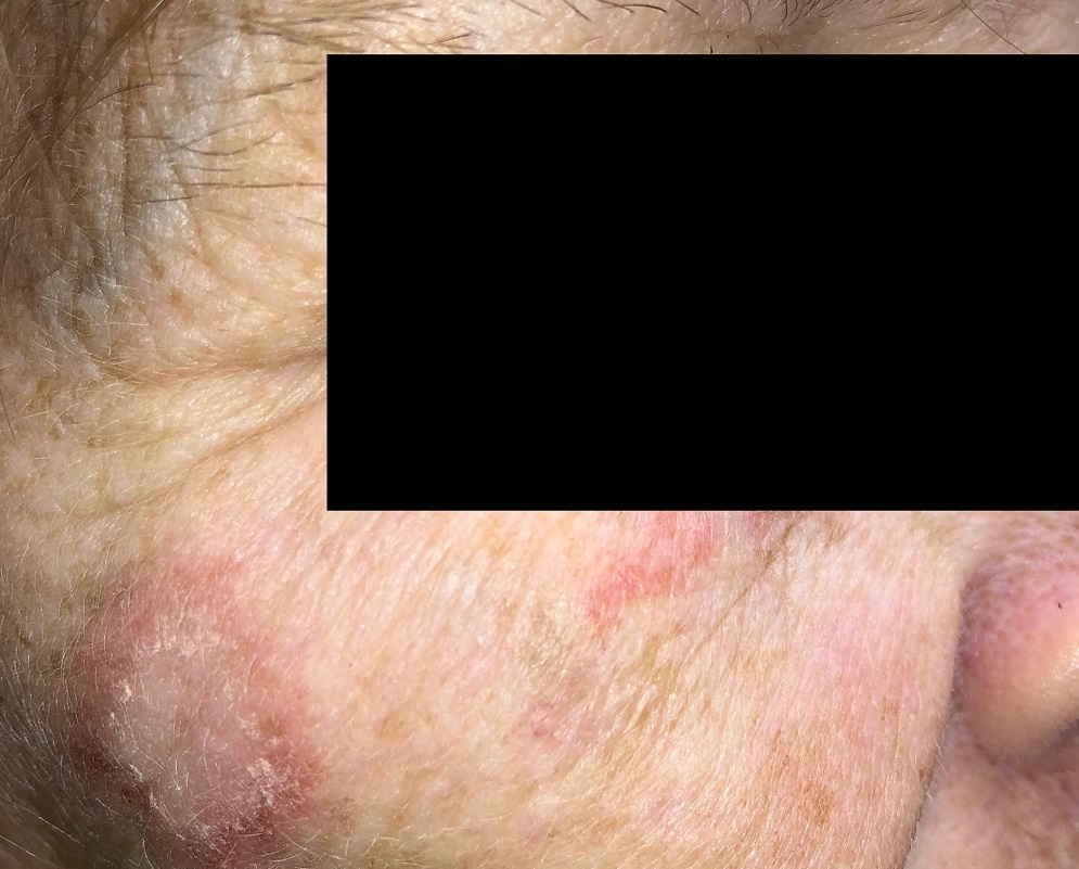 Discoid lupus erythematosus cheek from The Lupus Encyclopedia by Donald Thomas MD 1