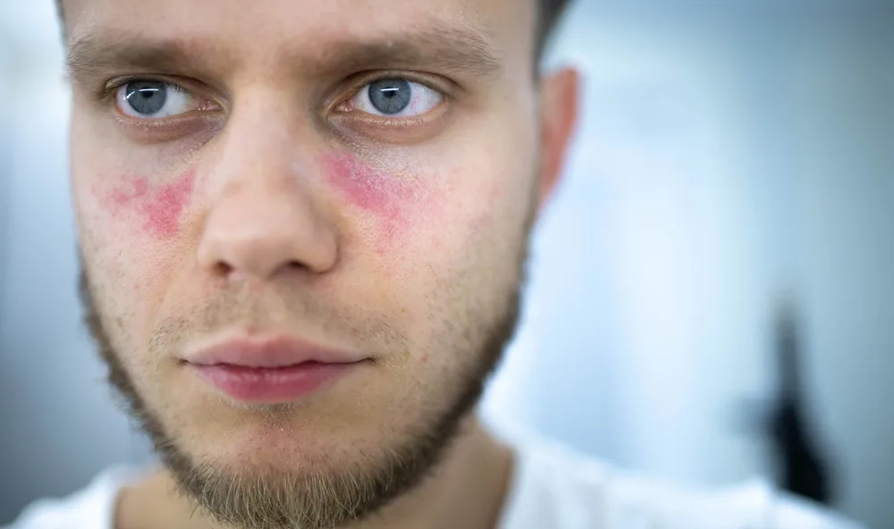Malar butterfly rash symptom of lupus