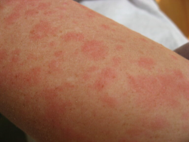 Lupus Mottled Skin and the Symptoms The Lupus Encyclopedia