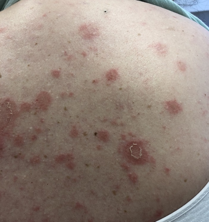 Subacute cutaneous lupus due to lansoprazole on the upper back of a white woman with systemic lupus