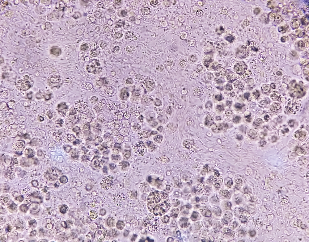 White blood cells in urine or pyuria