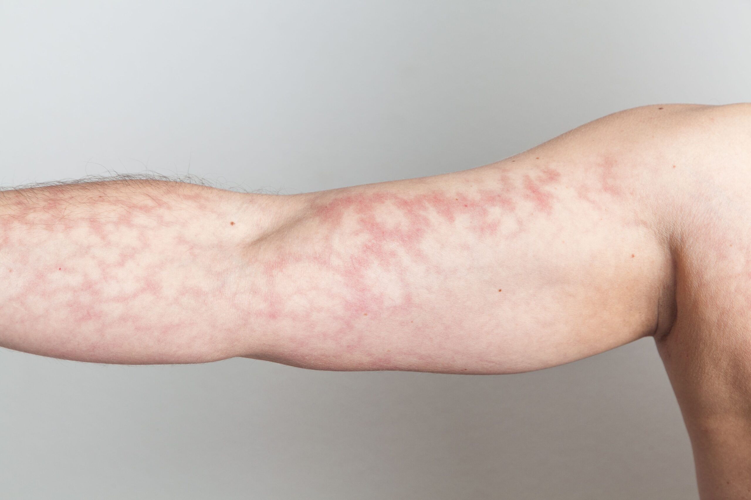 Lupus Mottled Skin