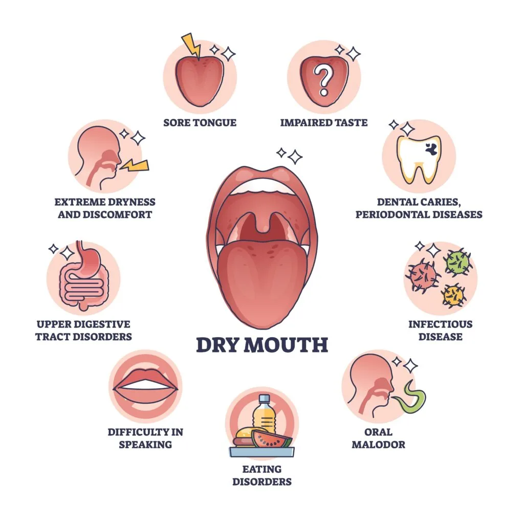 Image showing complications of dry mouth from lupus exocrine involvement