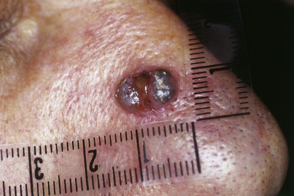 Lupus nose ulcers