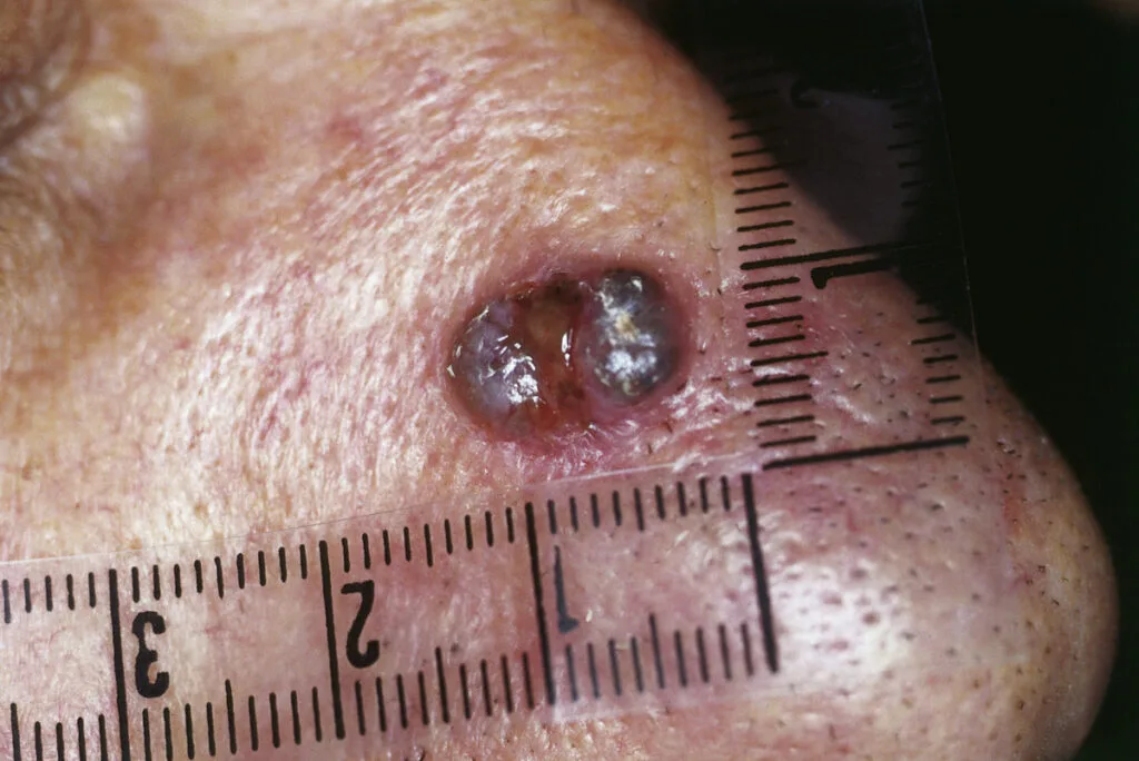 Lupus nose ulcers