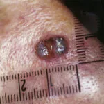 Lupus and Nose Ulcers