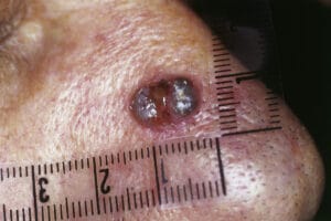 Lupus nose ulcers