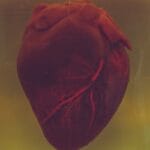 Heart Attacks, Strokes, and Blood Clots in Lupus