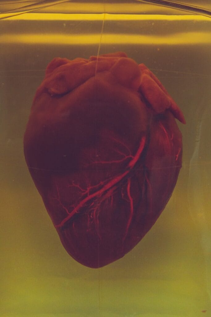 Heart Attacks, Strokes, and Blood Clots in Lupus