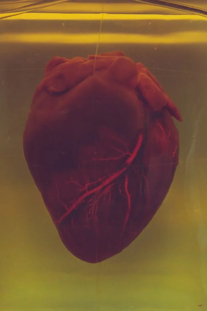 Heart Attacks, Strokes, and Blood Clots in Lupus