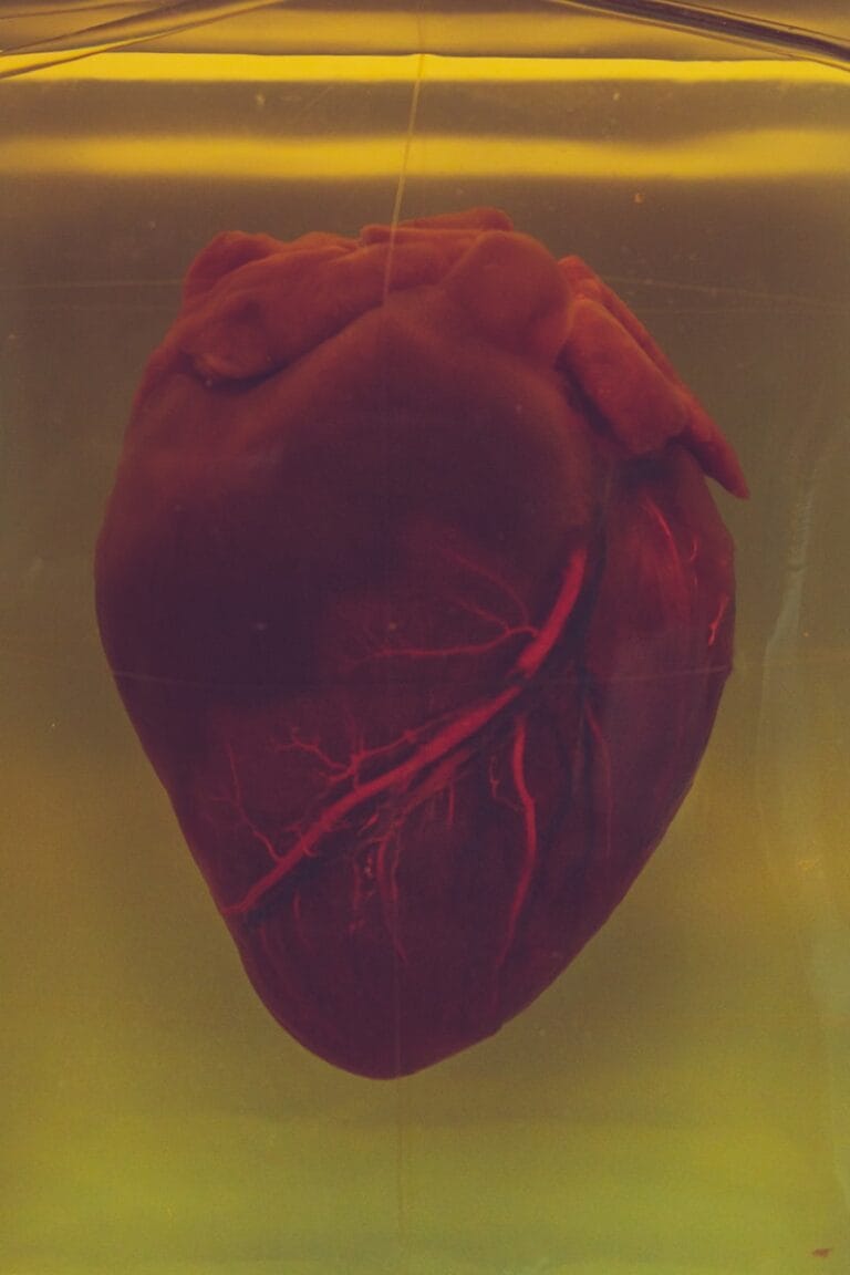 Heart Attacks, Strokes, and Blood Clots in Lupus