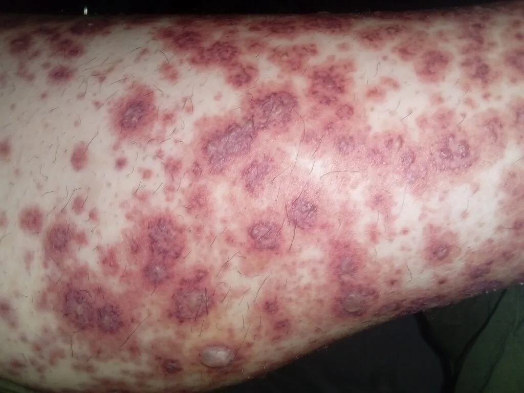 Lupus and purple spots on skin