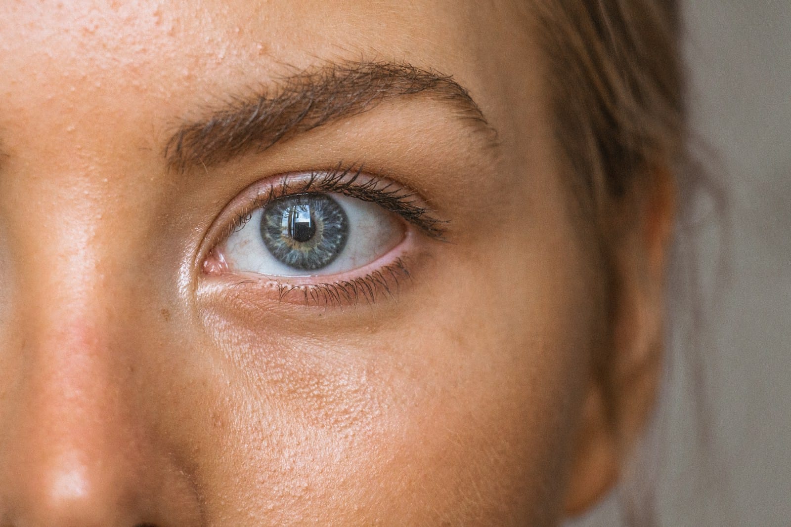 dry eyes in lupus