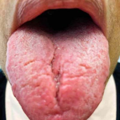 Furrowed tongue and thrush in lupus patient with Sjogrens overlap from The Lupus Encyclopedia by Donald Thomas MD