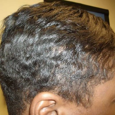 Photo of hair after successful treatment