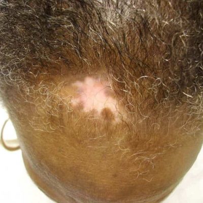 Photo of discoid lupus erythematosus (DLE) causing scarring alopecia