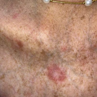 Discoid lupus on the upper chest near the clavicle of a white woman with systemic lupus