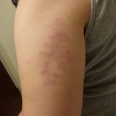 Photo of lupus profundus (lupus panniculitis) on the upper arm in a patient with SLE